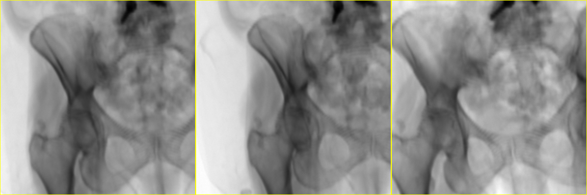 Example 2 Simulated Fluoroscopy