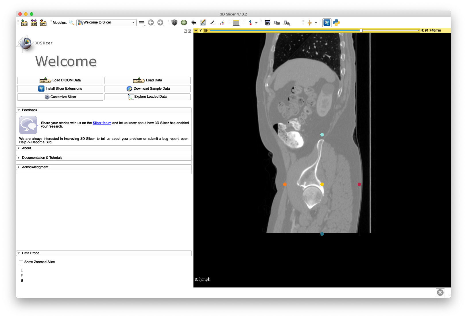 Slicer Sagittal ROI